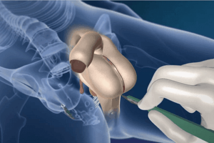 Male to female sex reassignment surgery