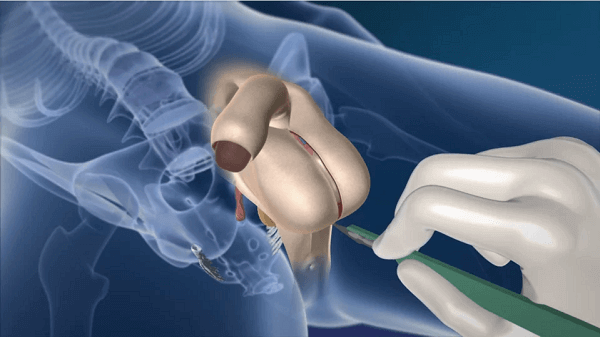 Male to female sex reassignment surgery