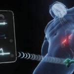 Screenshot from video clip demonstrating Morari wearable product for treating PE