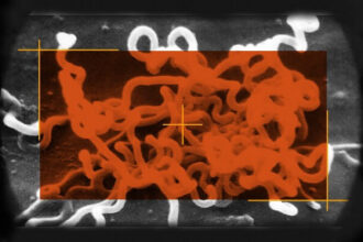 Image of Syphilis a Bacterium called Treponema Pallidum