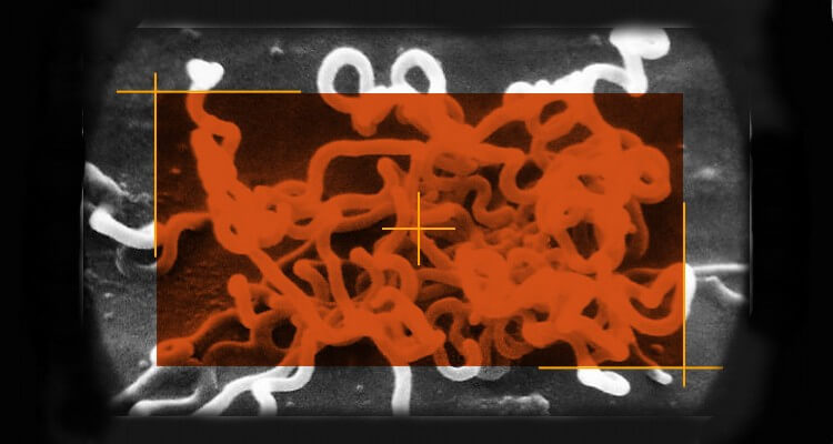 Image of Syphilis a Bacterium called Treponema Pallidum